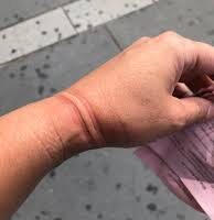 Indentation marks from narrow-bail handcuffs